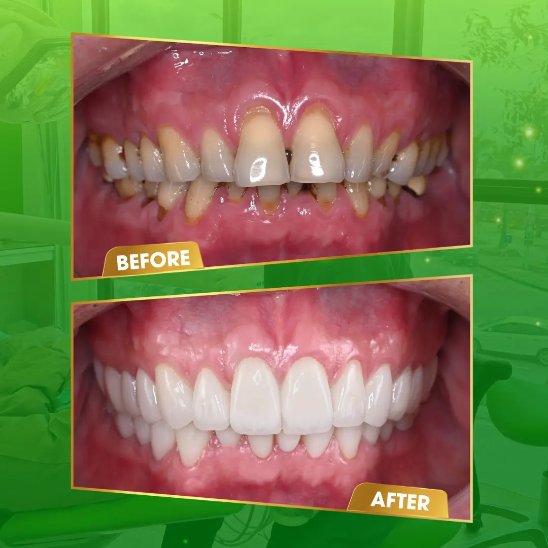 Dental Crowns – A Comprehensive Cosmetic Solution