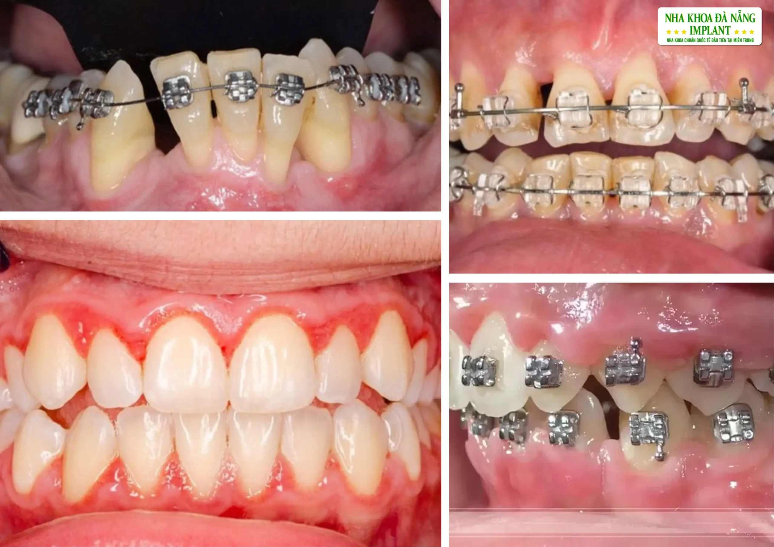 What Is Incorrect Orthodontic Treatment?