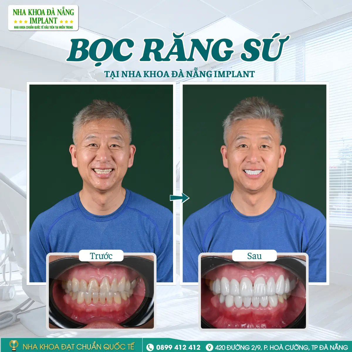 Những lưu ý quan trọng cho khách làm răng sứ trong thời gian ngắn 10 Hình ảnh before - after: Giá trị thực tế không thể thay thế