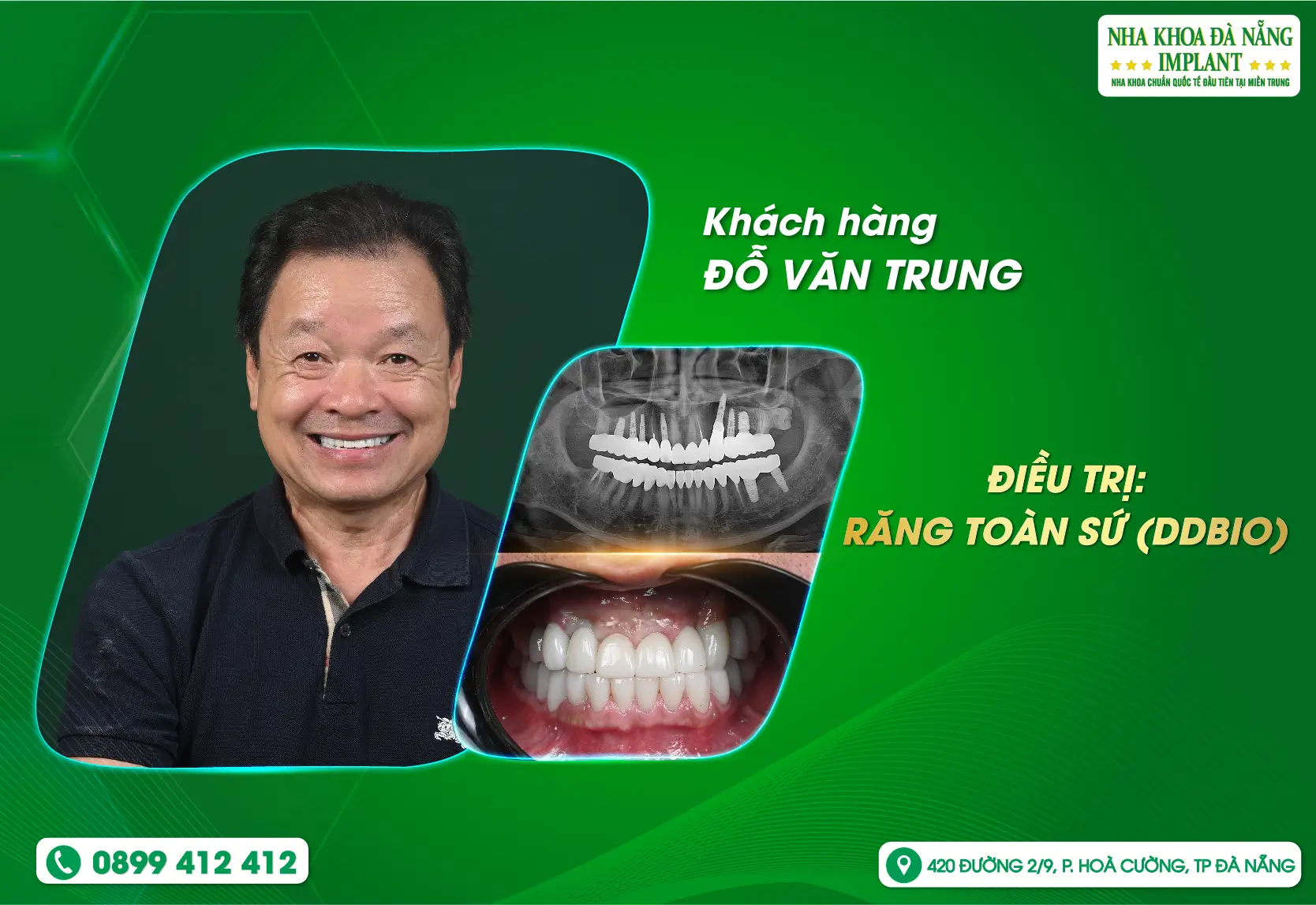 Khách hàng Việt Kiều trở về quê hương và lựa chọn Nha Khoa Đà Nẵng Implant