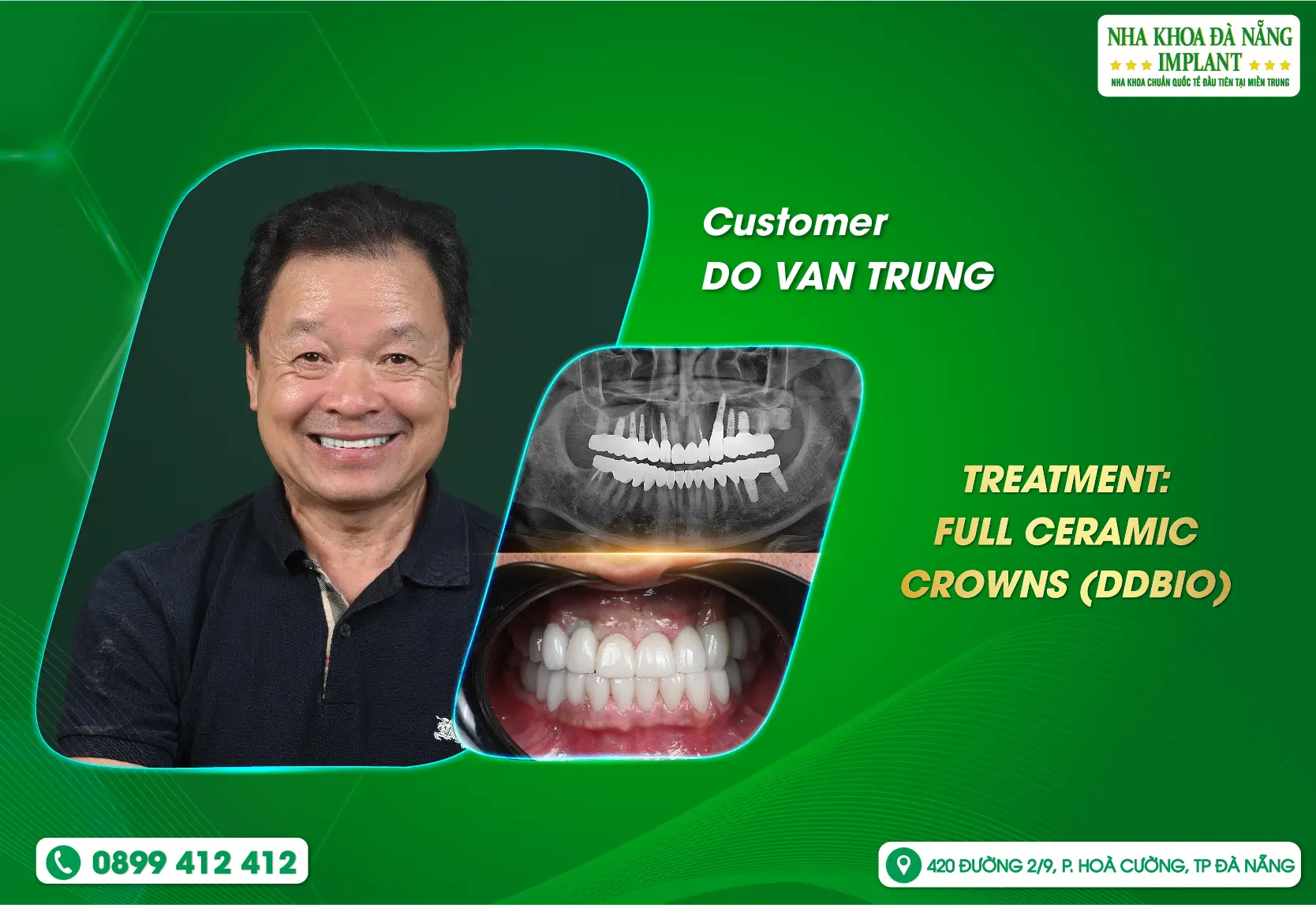 Overseas Vietnamese returning home choose Da Nang Implant Dental Clinic