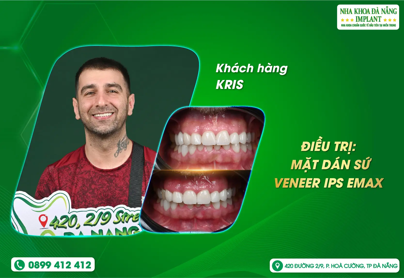 Bọc răng sứ có cải thiện được răng thiếu sức sống do hút thuốc lá