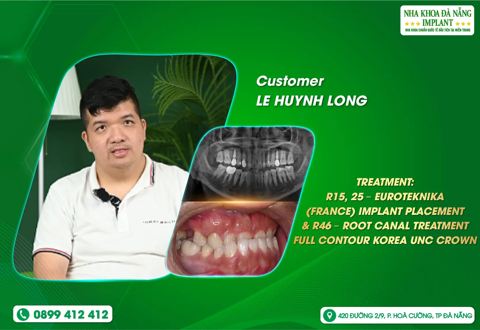 A journey back to Vietnam – rediscovering a complete smile at Da Nang Implant Dental Clinic