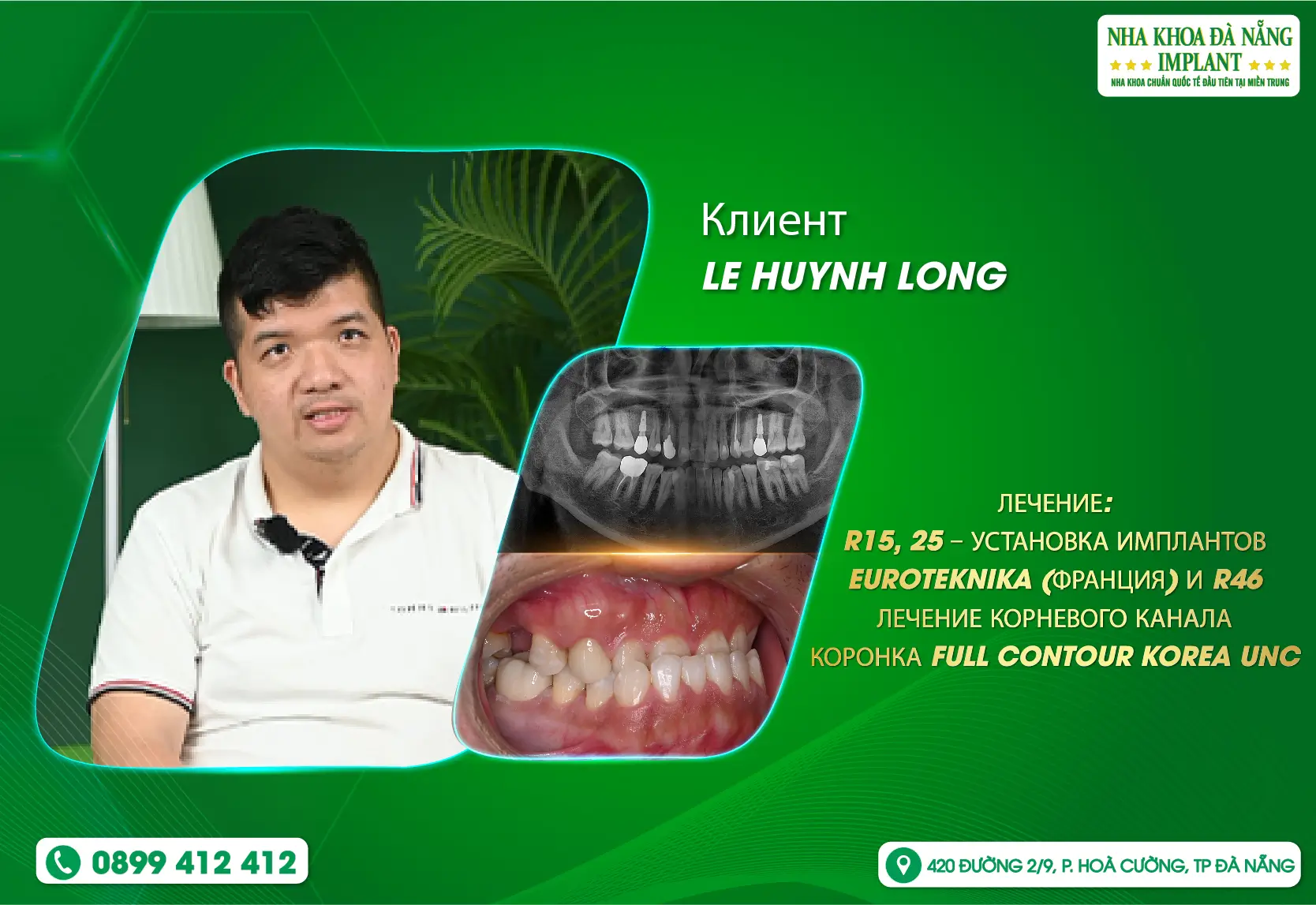 Возвращение во Вьетнам — путь к полноценной улыбке в Da Nang Implant Dental Clinic