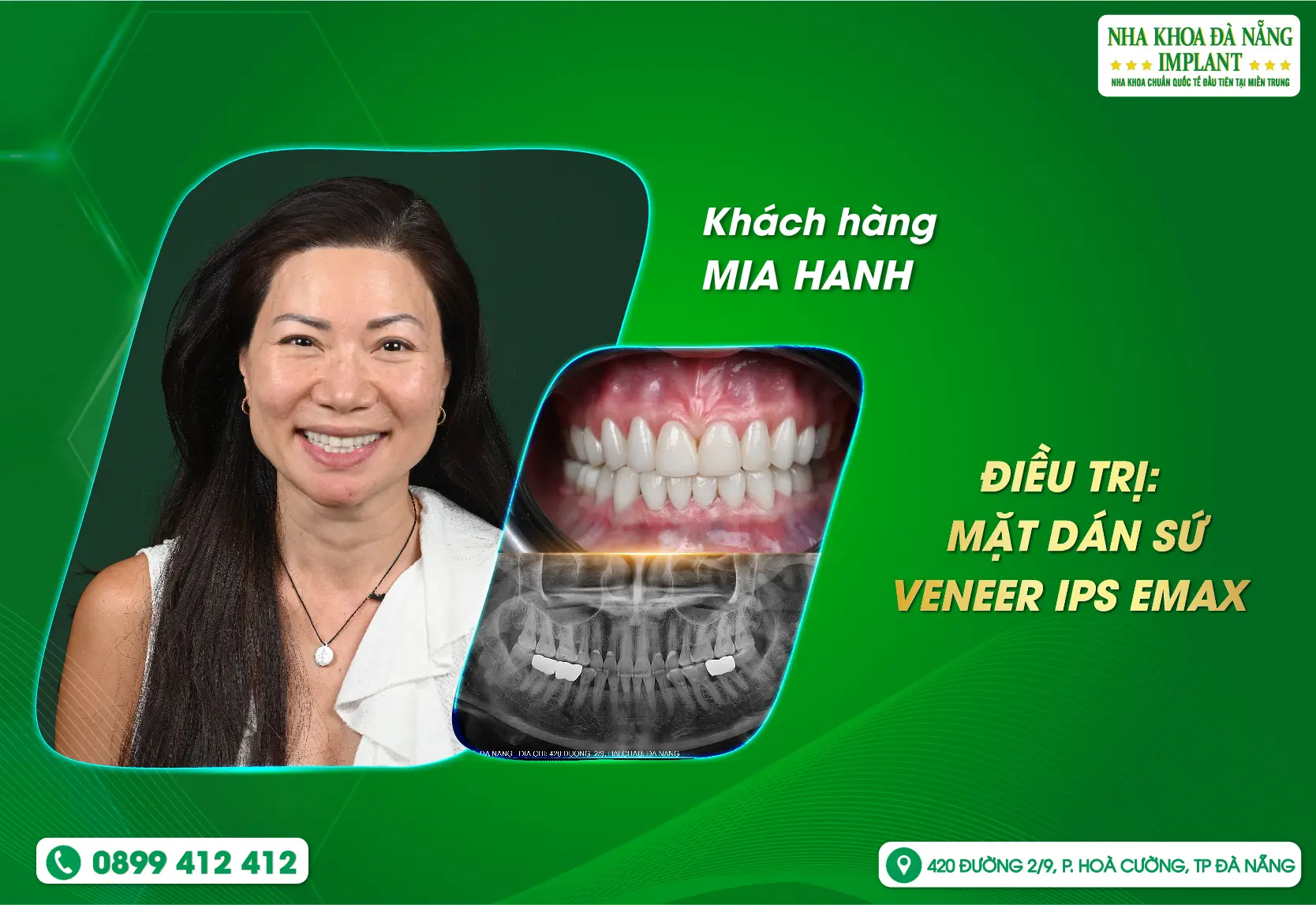 Khách hàng từ Hoa Kỳ trở về Việt Nam để thực hiện phương pháp dán sứ Veneer