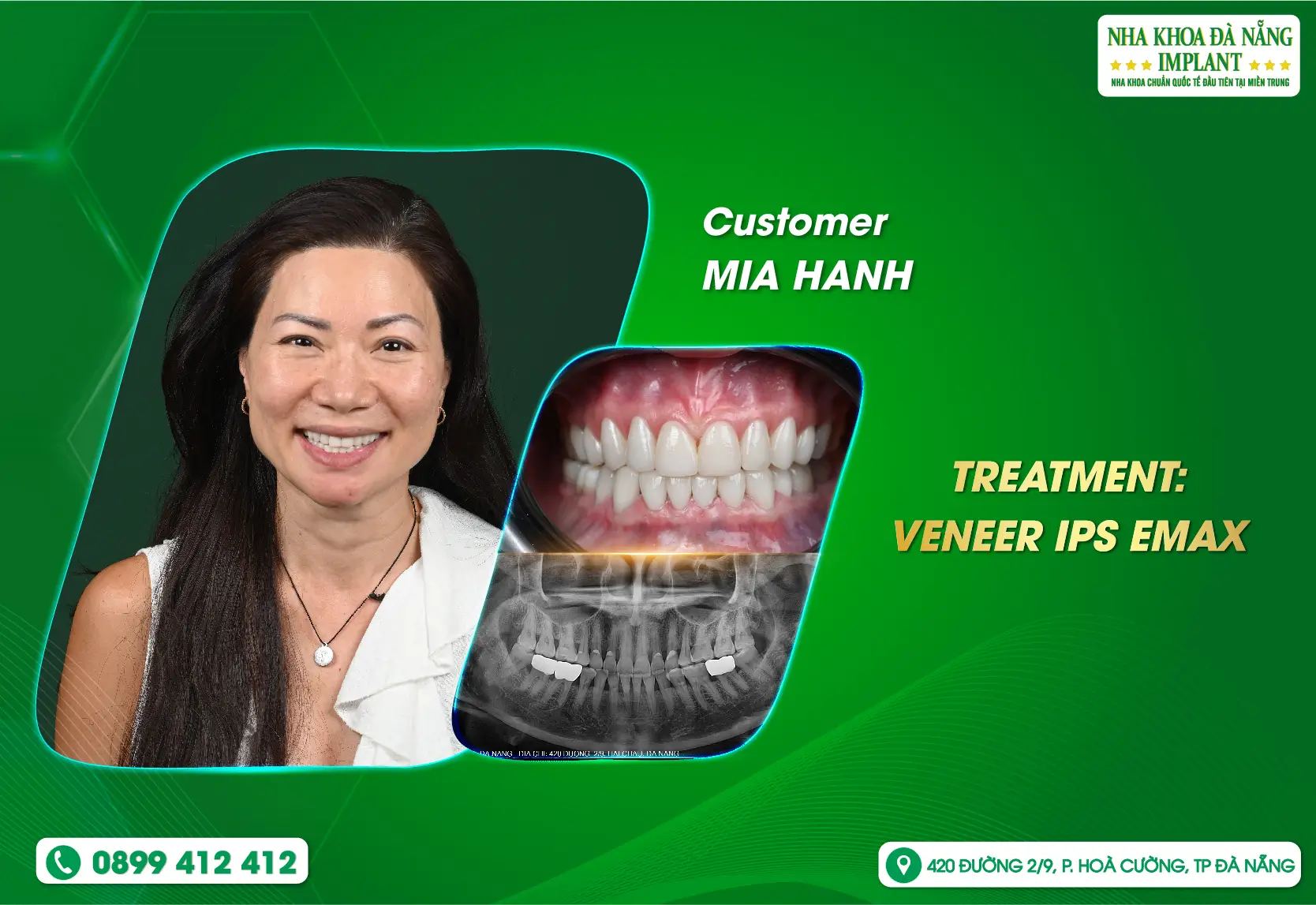 A customer from the United States returned to Vietnam to undergo Veneer treatment.