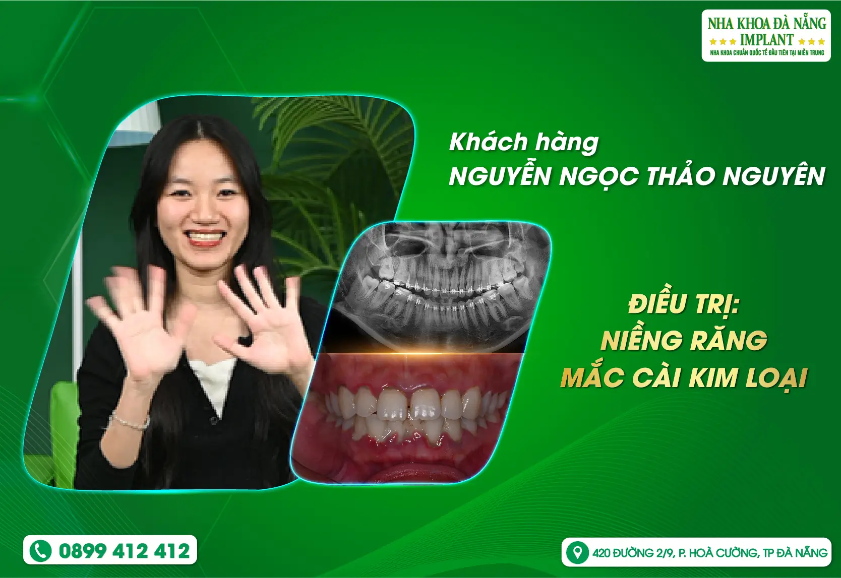 Hành trình trở về Việt Nam – tìm lại nụ cười trọn vẹn tại Nha Khoa Đà Nẵng Implant