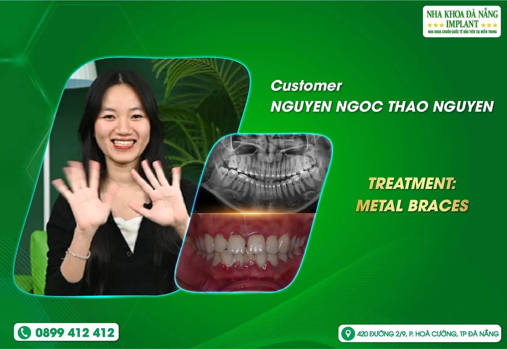 A journey back to Vietnam – rediscovering a complete smile at Da Nang Implant Dental Clinic