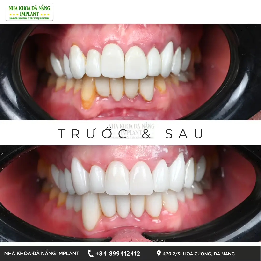 Bọc răng sứ tại Nha Khoa Đà Nẵng Implant