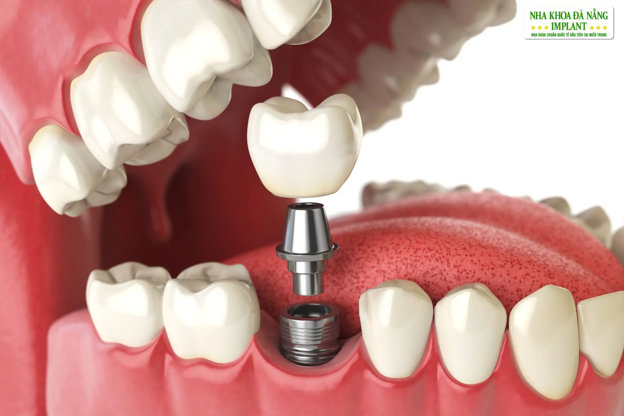 What is an Implant Fixture?