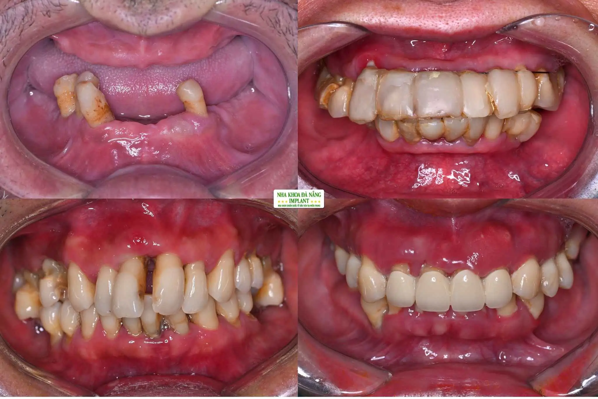 Trường hợp NÀO CẦN ghép xương?