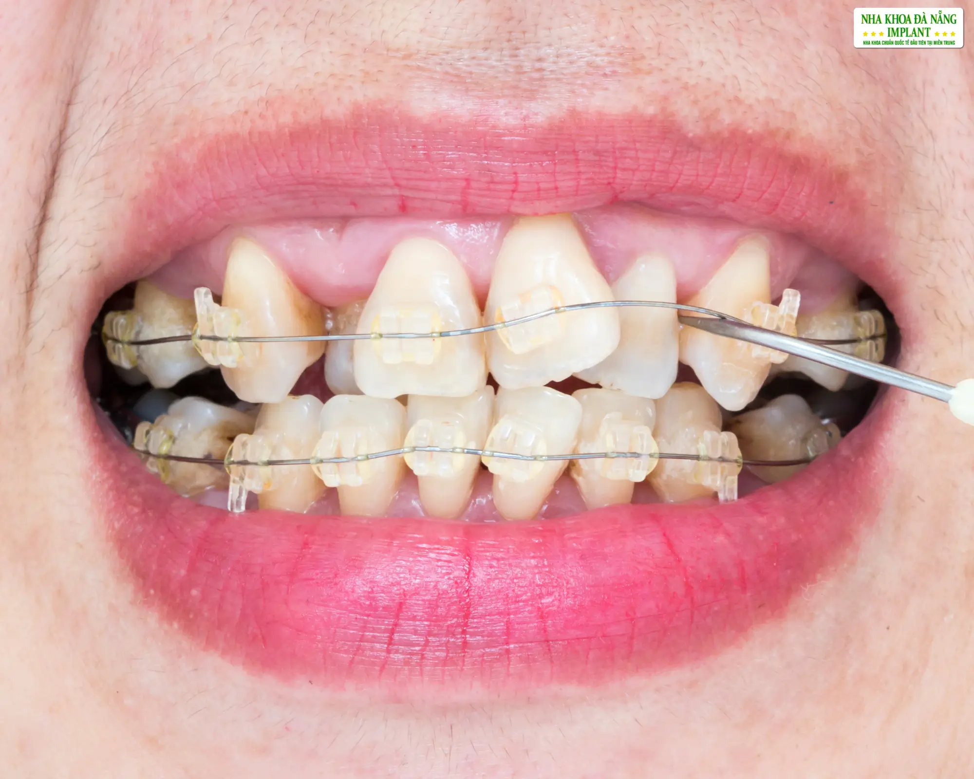 Consequences of Incorrect Orthodontic Treatment