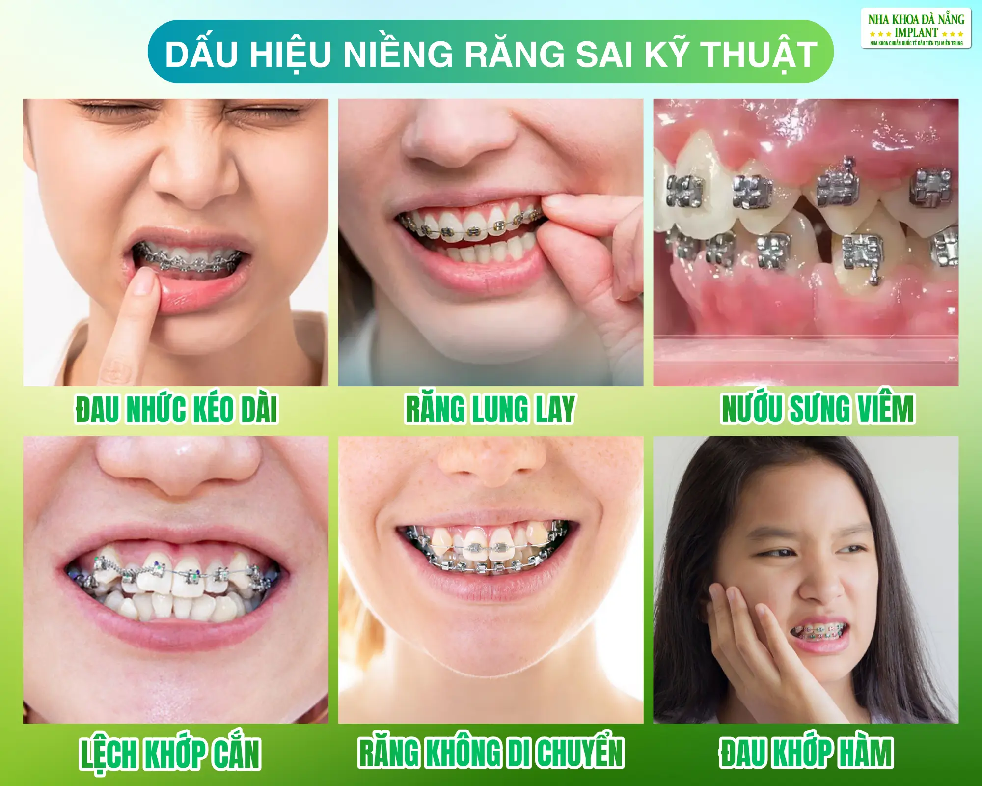 Những Dấu Hiệu Niềng Răng Sai Kỹ Thuật Cần Nhận Biết Sớm
