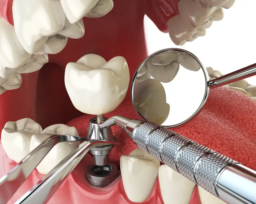 Можно ли установить импланты до Нового года?