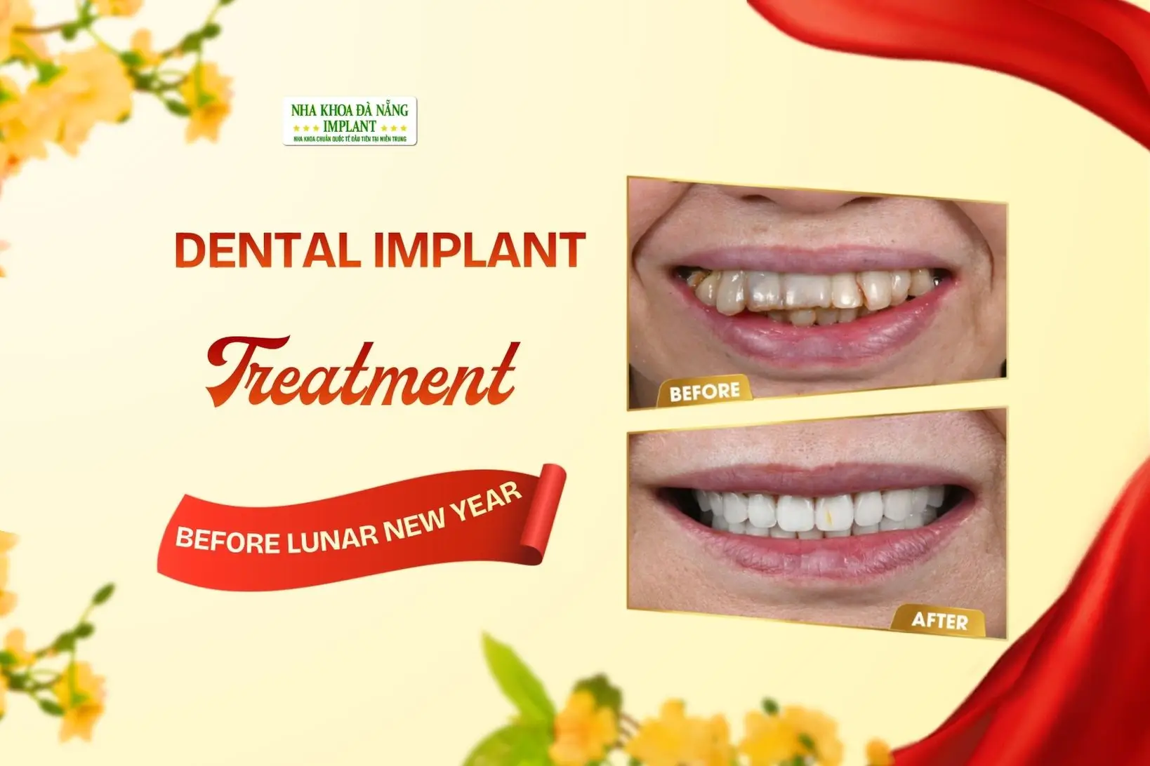 Is It Possible to Get Dental Implants Before the New Year? What You Need to Know