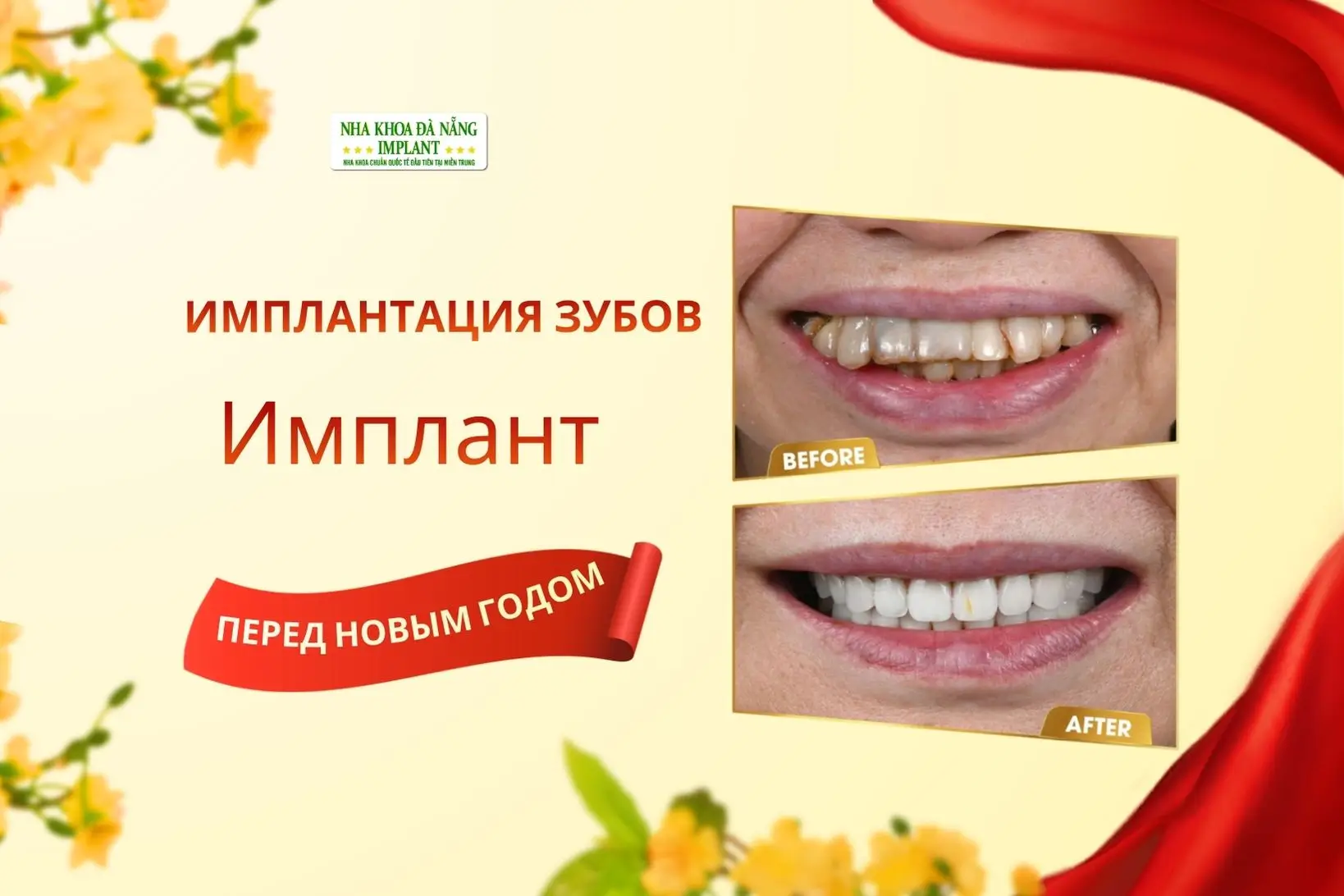 Успеете ли вы установить зубные импланты до Нового года? Что важно знать