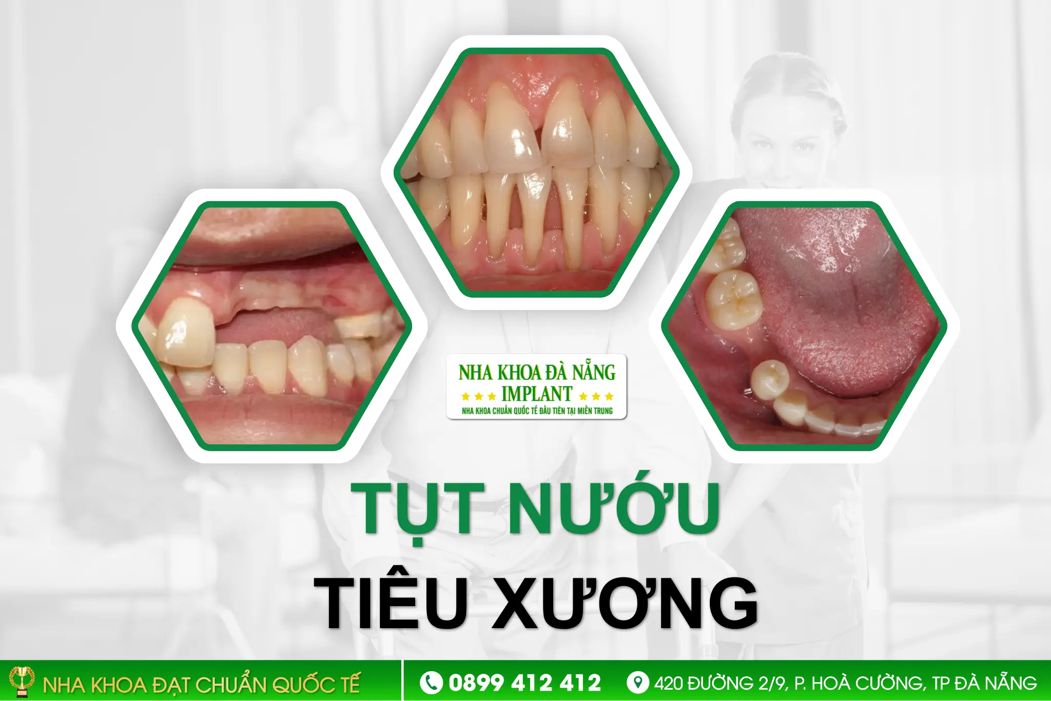 Nướu tụt và tiêu xương ổ răng
