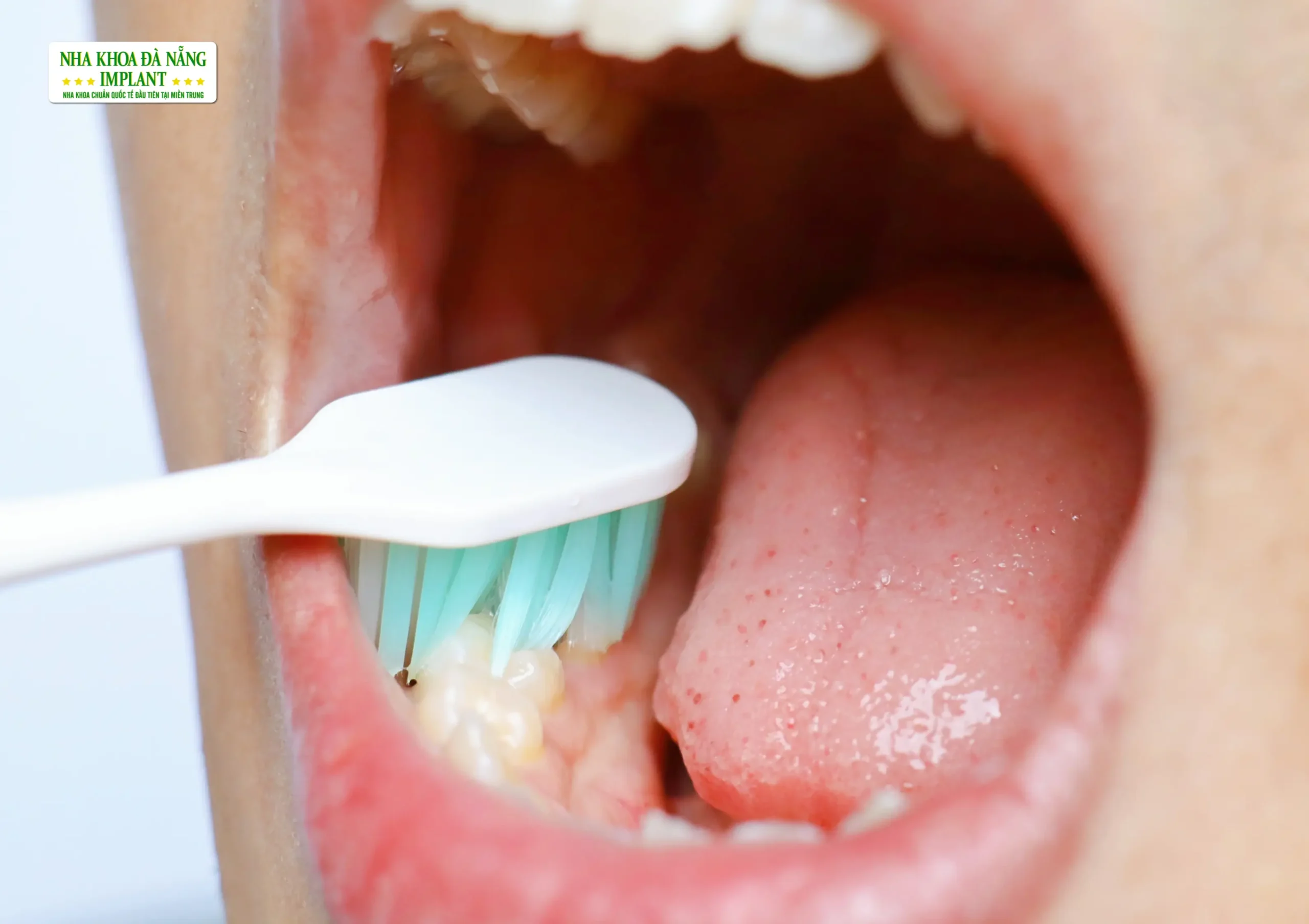 Chỉ Đánh Răng Mà Không Làm Sạch Kẽ Răng