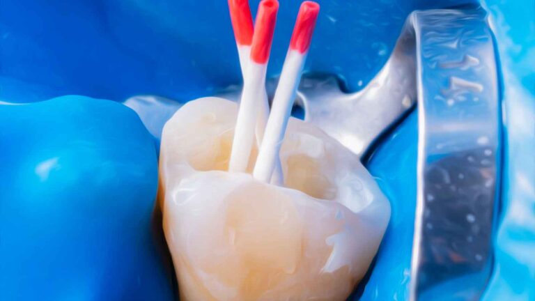 Điều trị tủy răng là 1 thủ thuật nha khoa 