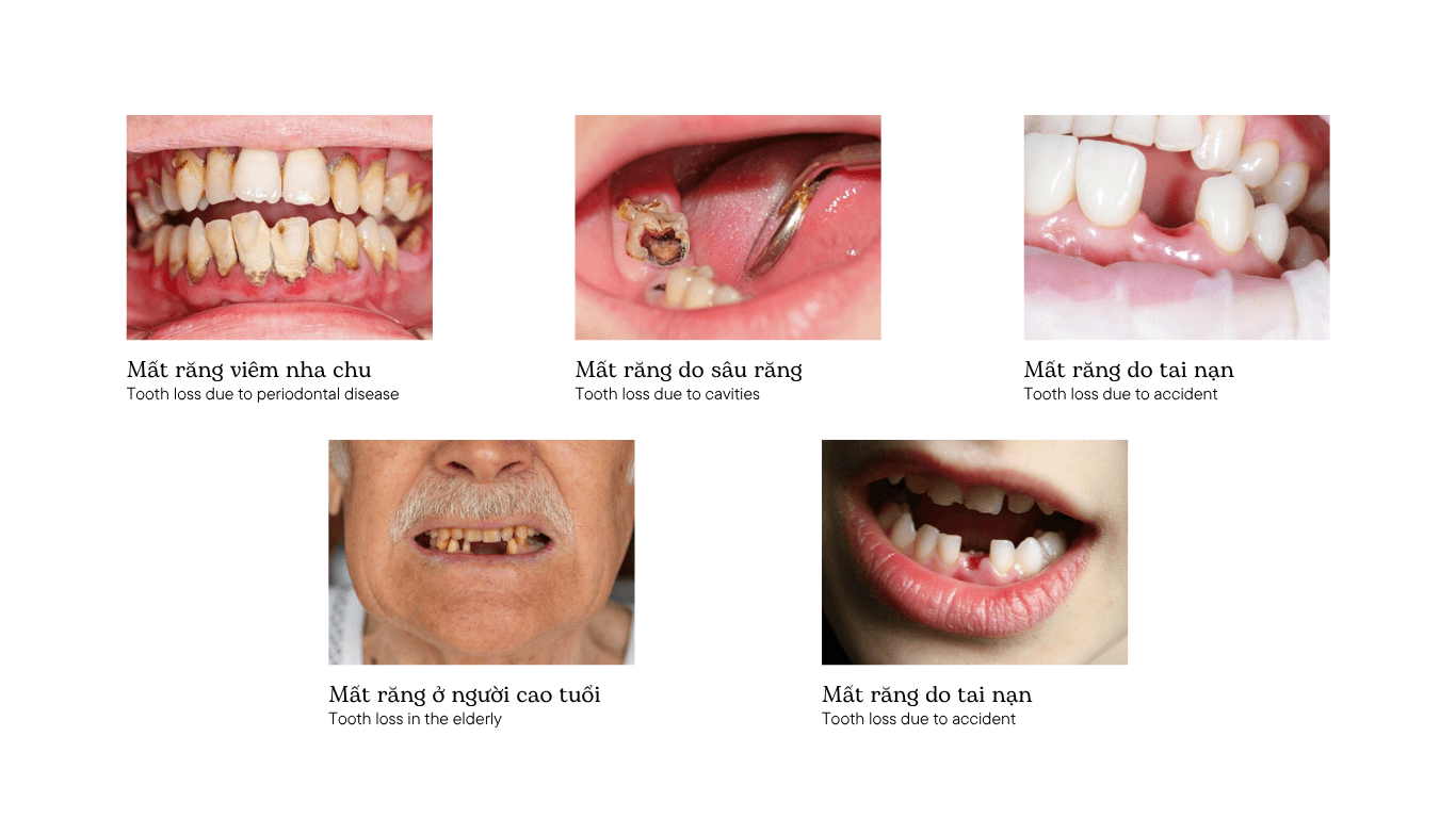 Последствия потери зубов и 5 опасных осложнений, о которых вам нужно знать 6 Причины потери зубов
