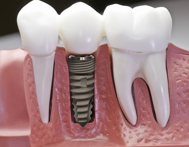 Phải cấy ghép implant nếu không điều trị sớm 