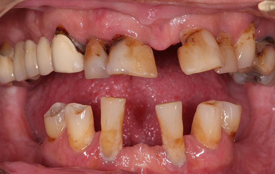 6 Quy Trình Trồng Răng Implant Từ A-Z: Mất Bao Lâu? Bao Nhiêu Tiền? 10 mất 1 răng, nhiều răng hoặc toàn hàm, sâu răng