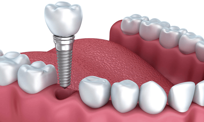 6 Quy Trình Trồng Răng Implant Từ A-Z: Mất Bao Lâu? Bao Nhiêu Tiền? 9 Implant cải thiện tình trạng mất răng