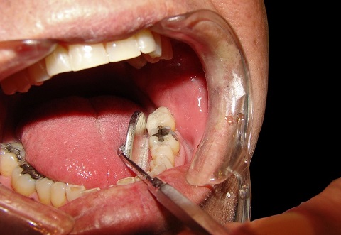 Nên điều trị tủy sớm để tránh những hậu quả về sau