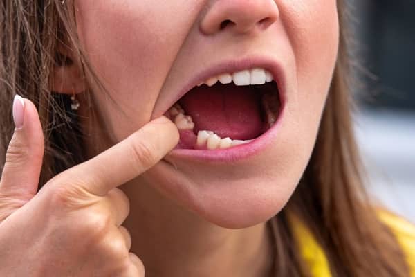 mất răng không chỉ ảnh hưởng đến thẩm mỹ 
