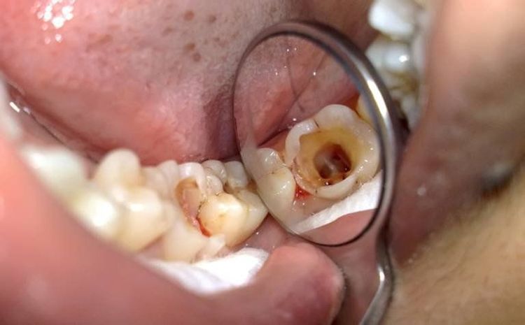 Điều trị tủy