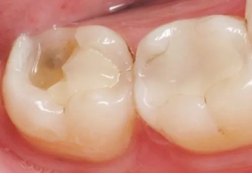 7 DẤU HIỆU BẠN CẦN PHỤC HÌNH RĂNG SỚM ĐỂ KHÔNG TỐN THÊM 30–50% CHI PHÍ TRONG TƯƠNG LA