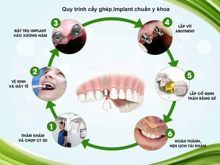 6 Quy Trình Trồng Răng Implant Từ A-Z: Mất Bao Lâu? Bao Nhiêu Tiền? 11 Quy trình trồng răng Implant thường trải qua nhiều bước khác nhau nhằm đảm bảo Implant tích hợp tốt với xương hàm và đạt độ ổn định lâu dài.