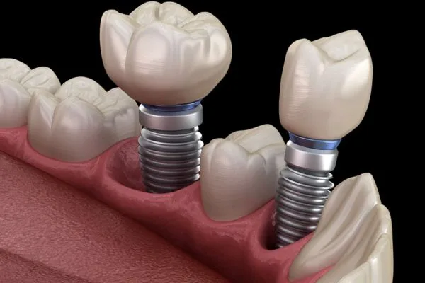 6 Quy Trình Trồng Răng Implant Từ A-Z: Mất Bao Lâu? Bao Nhiêu Tiền? 12 Thời gian trồng implant từ 3-6 tháng