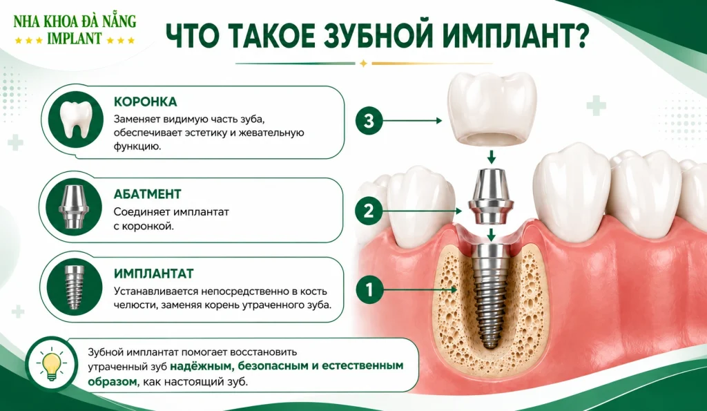 Строение дентального имплантата
