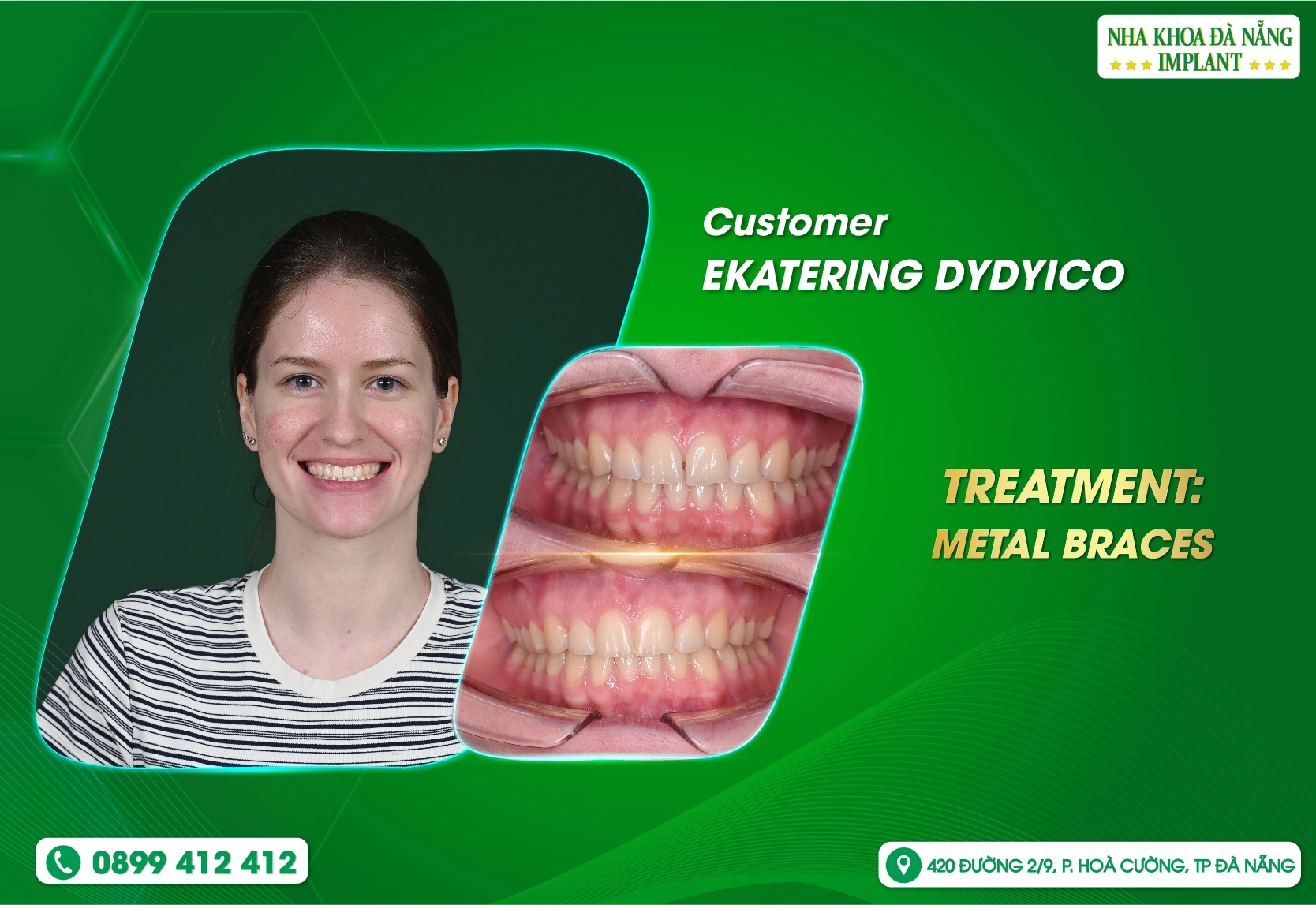  Điều gì khiến cô gái người Nga tin tưởng niềng răng tại Nha khoa Đà Nẵng Implant?
