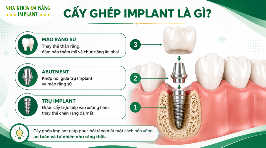 8 Trường Hợp Không Nên Cấy Implant Ngay – Bác Sĩ Ít Khi Nói Rõ 7 Cấu tạo của một ca cấy ghép implant