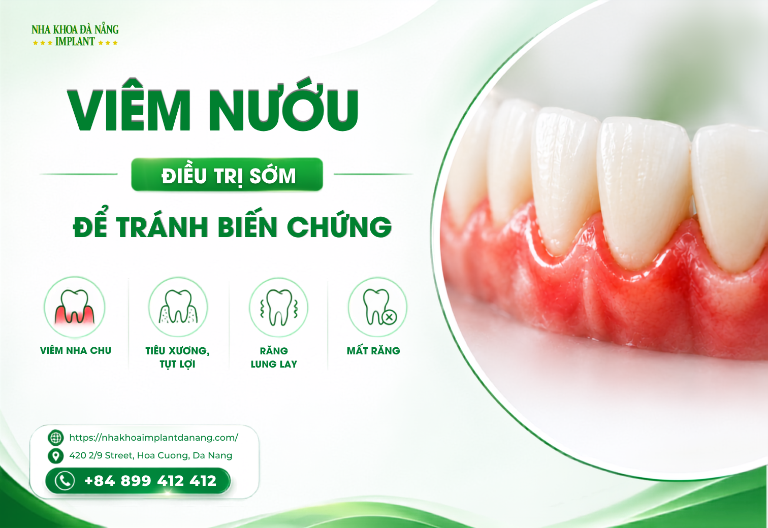 Điều Trị Viêm Nướu Sớm Giúp Tránh Những Biến Chứng Nào?