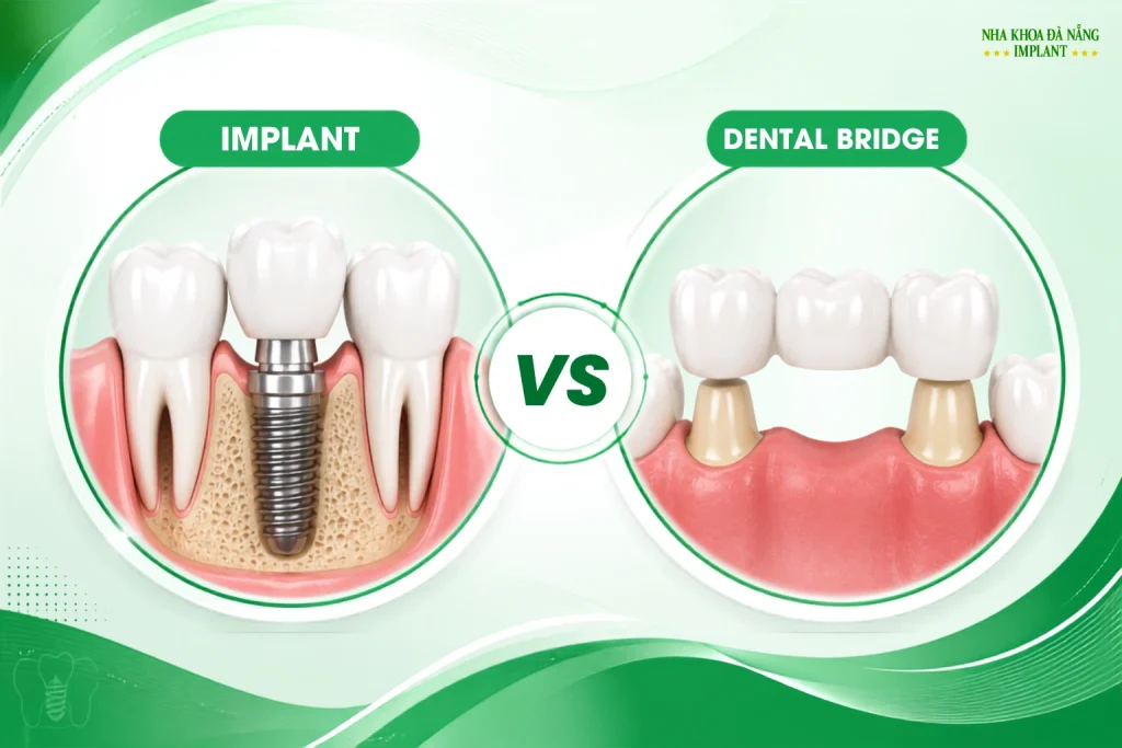 Implant or Dental Bridge