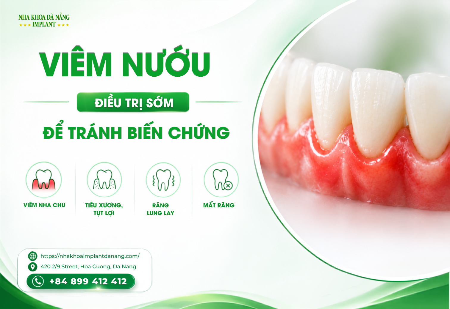 Điều Trị Viêm Nướu Sớm Giúp Tránh Những Biến Chứng Nào?
