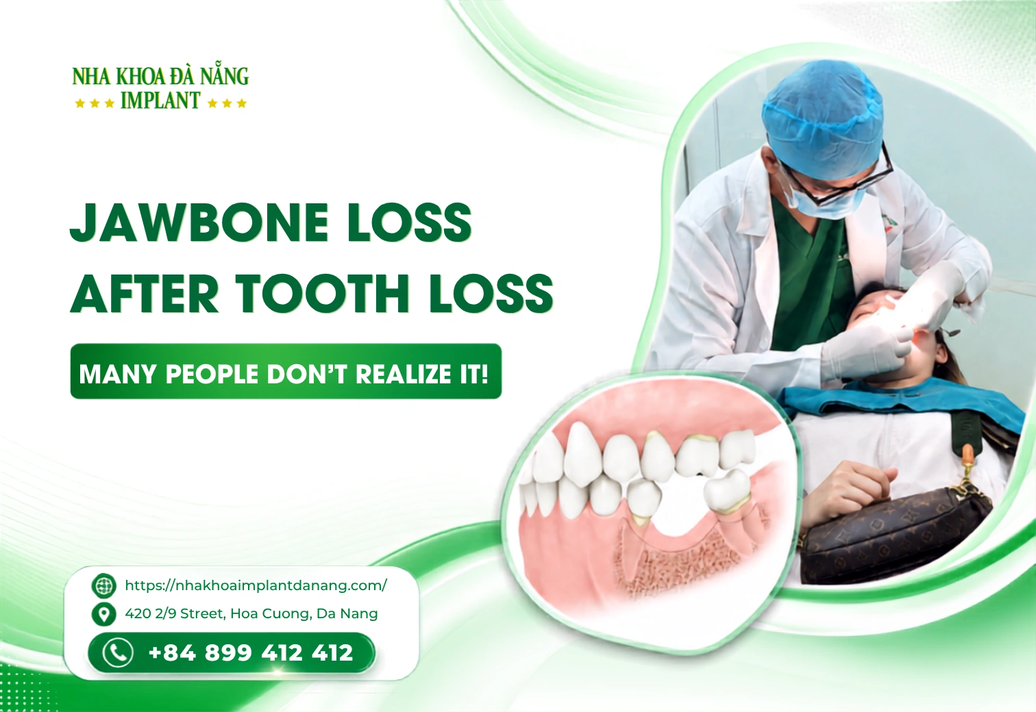Jawbone Loss After Tooth Loss: A Common Problem Many People Don’t Notice