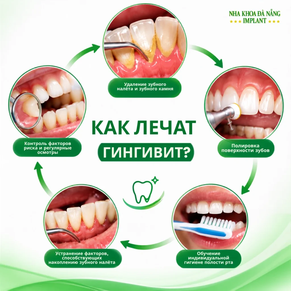 Как лечат гингивит?