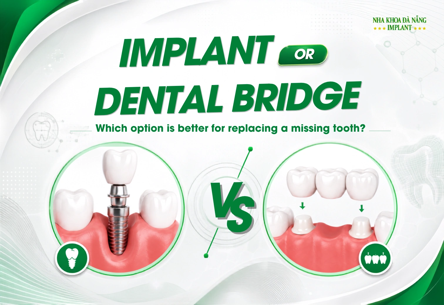 Implant or Dental Bridge: Which Is Better for Replacing a Single Missing Tooth?