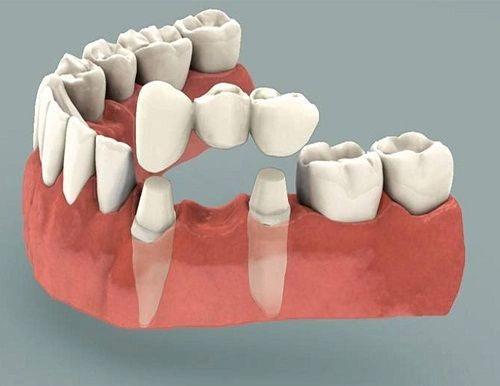 What Is a Dental Bridge?