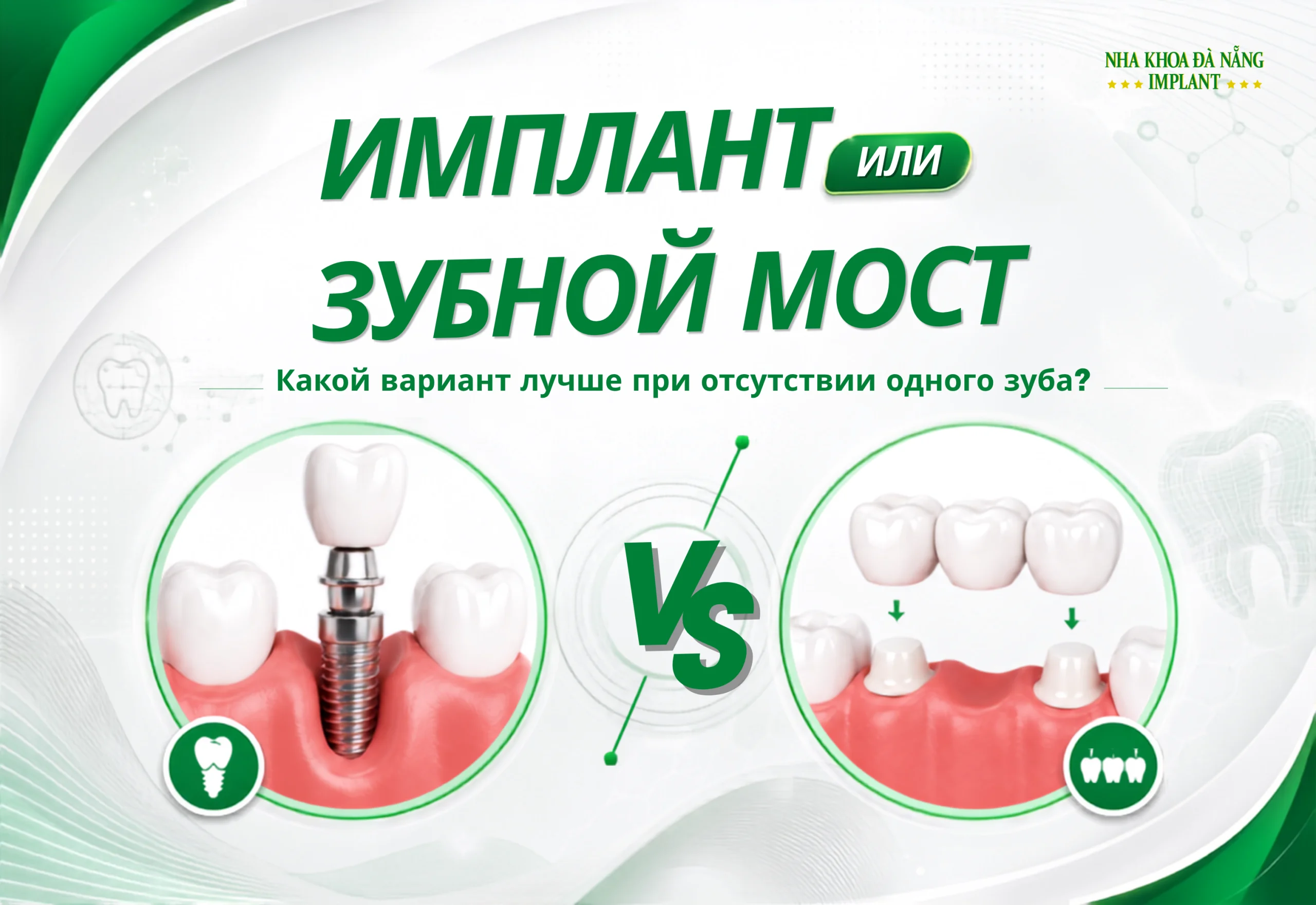 Имплант или мостовидный протез: что лучше при отсутствии одного зуба?