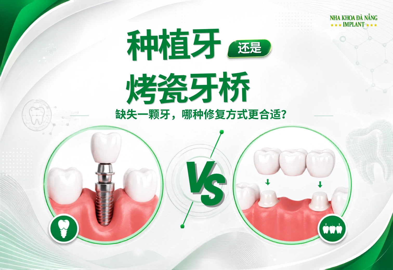 种植牙还是牙桥：单颗缺牙修复哪个更好？