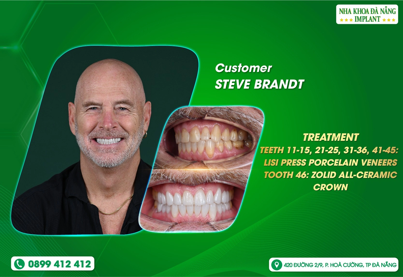 🦷 “I’m very happy with my new smile.”