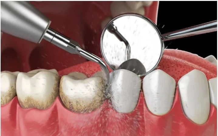 Vì Sao Phải Đến Nha Khoa Kiểm Tra Răng Miệng Định Kỳ? 11 Kiểm tra răng