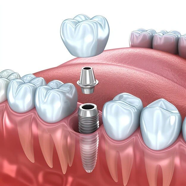 Tiêu Xương Hàm Sau Khi Mất Răng! Nhiều Người Không Nhận Ra 12 Hình mô phỏng trồng Implant