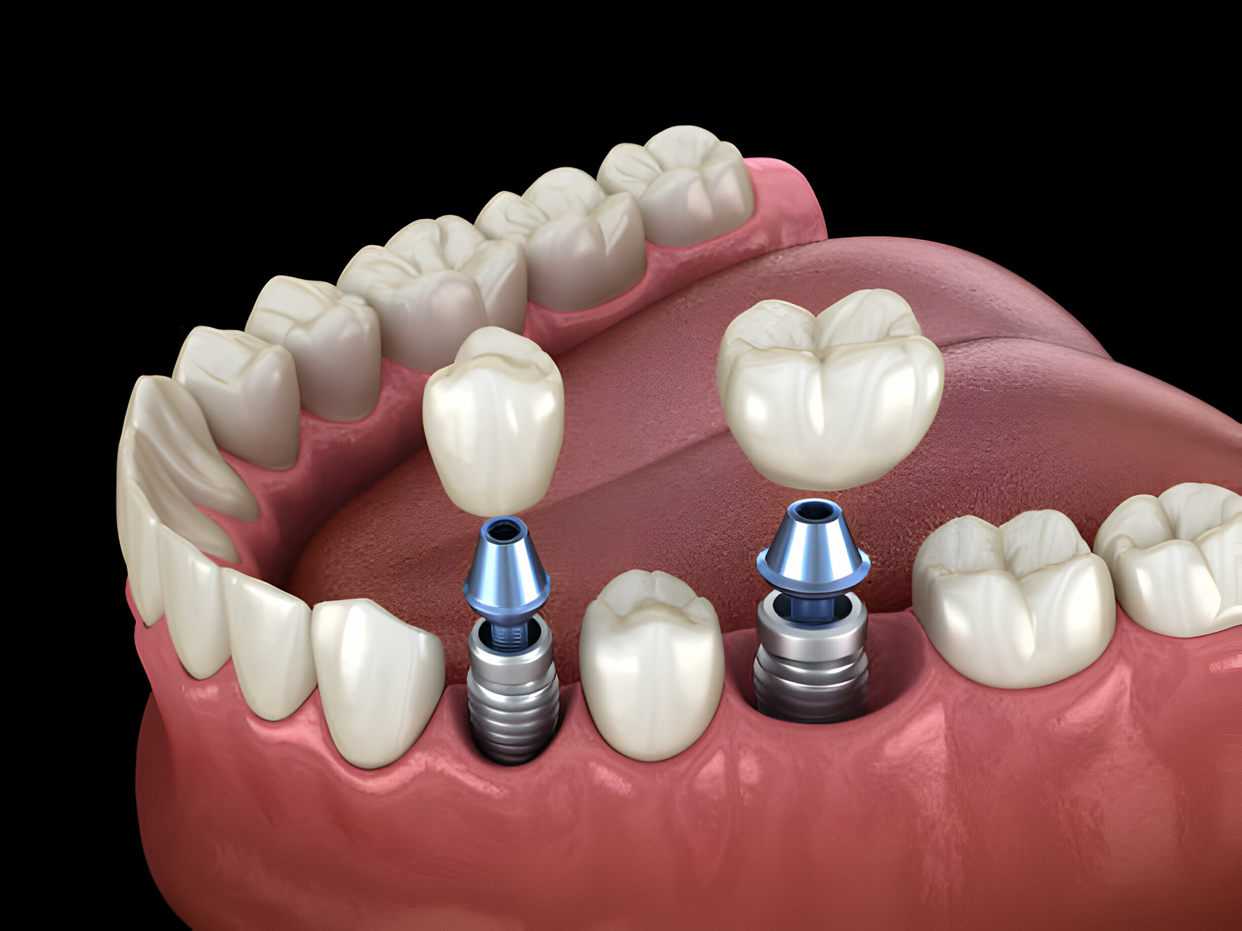 Hình minh hoạ trồng răng Implant