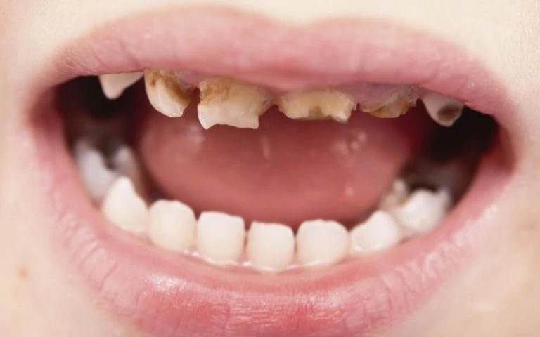 Vì Sao Phải Đến Nha Khoa Kiểm Tra Răng Miệng Định Kỳ? 9 Hình ảnh sâu răng